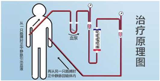 治疗效果: 1.使用先进的国外分子筛技术,对全身的血液进行过滤,将血液中的乙肝病毒大幅度地吸附截留,然后过滤掉血液中的病毒,再将无病毒的血液回输体内. 2.乙肝病毒血液截留吸附系统打破病毒复制模板,是病毒无法精心复制繁衍. 3能够快速减少病毒在体内的负荷,减少不应答性. 4.能都减少肝损害与肝硬变的几率.