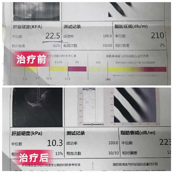 郑州治疗乙肝好的医院是哪家